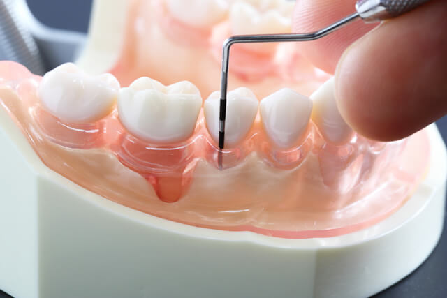 歯周病について