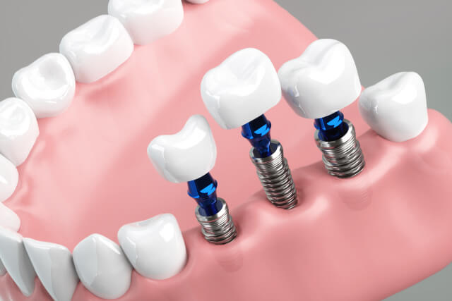 インプラントについて